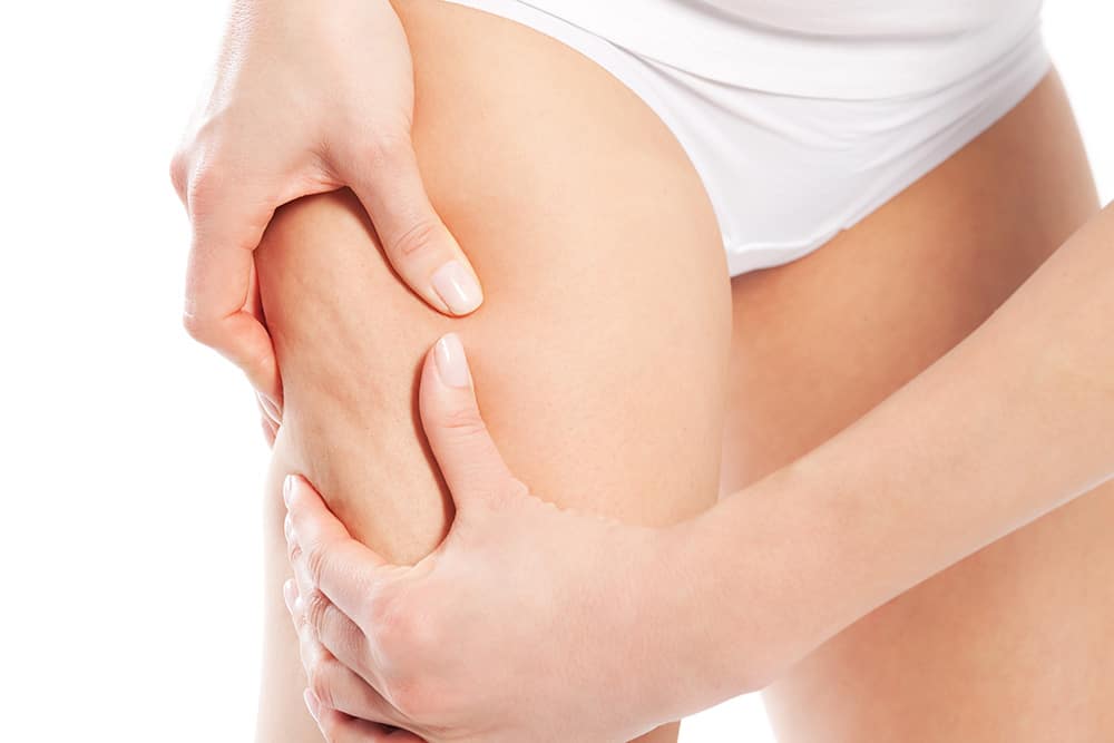 come curare la cellulite